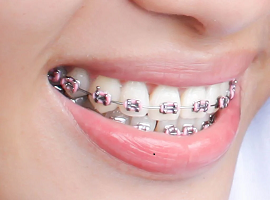 Orthodontic treatment in ahmedabad