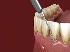 Periodontal disease treatment